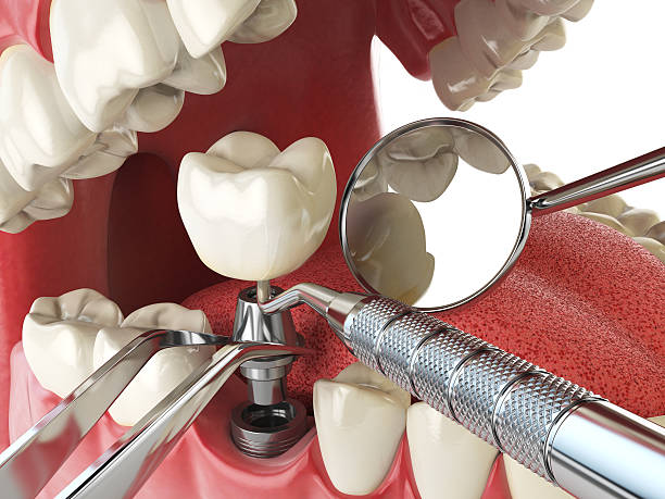 Best Chipped Tooth Repair Near Me  in Mount Pulaski, IL